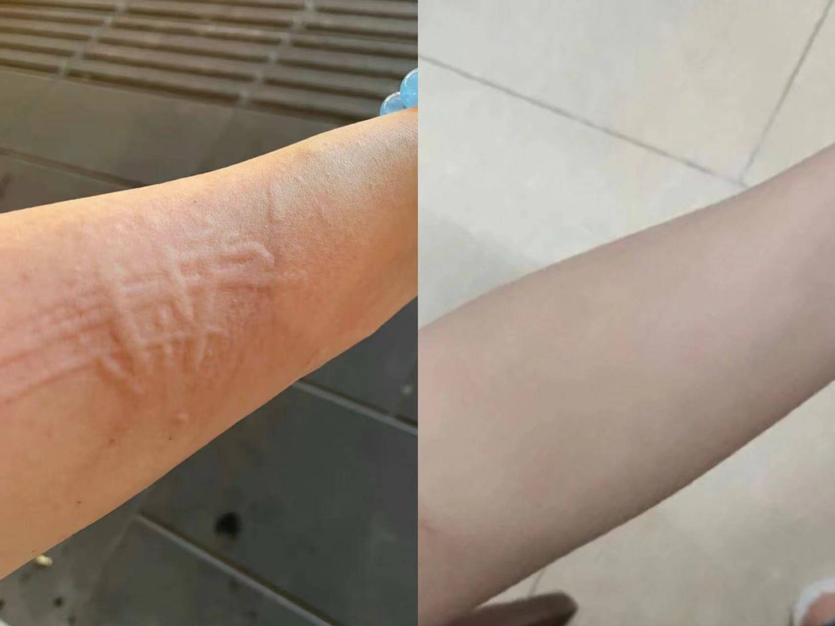 快试试它!荨麻疹见了都要怕!_皮肤_治疗_单说