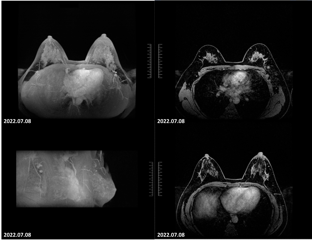 2022-07-08乳腺mri報告:左乳上方象限病變可見明顯強化,邊界不清,大小