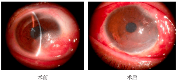 角膜囊肿图片