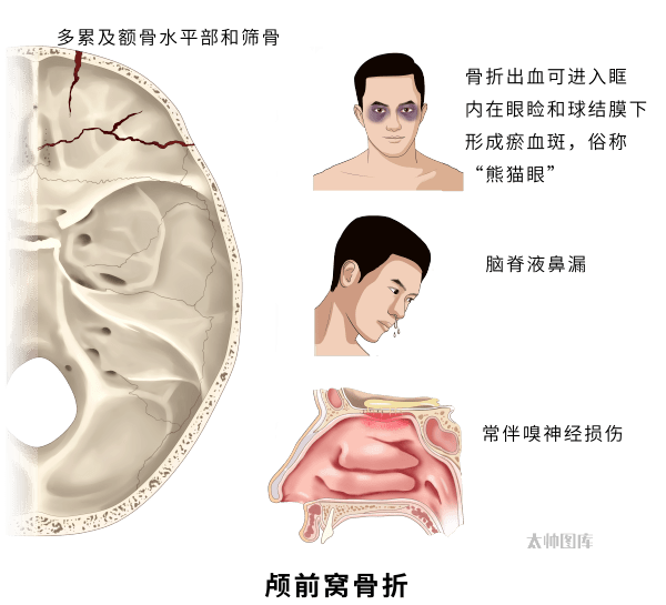 4 颅前窝骨折:熊猫眼征 鼻出血 脑脊液鼻漏 Ⅰ或Ⅱ脑神经损伤3