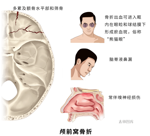 颅后窝骨折图片