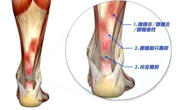 我珍藏的跟腱炎方法大公佈!親身經歷過才懂你!_運動_小腿肚_兩腿