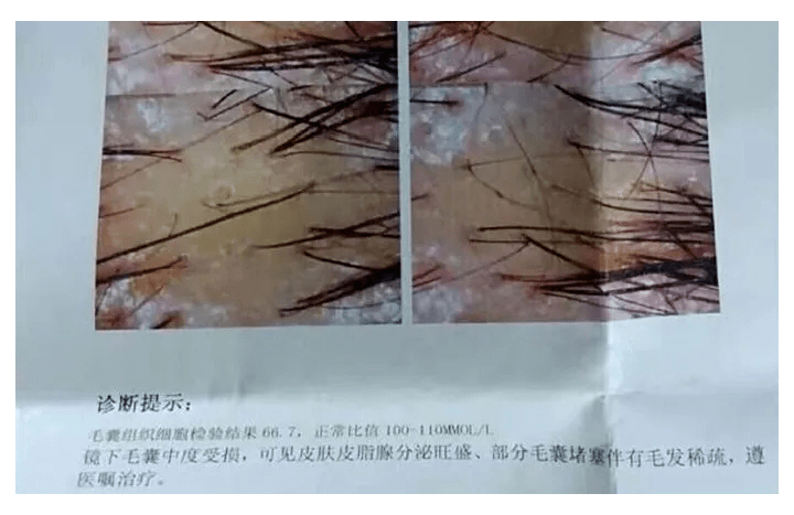 头油头痒,竟然要去医院检查?头上有这些问题要注意!_头皮_海盐_洗发
