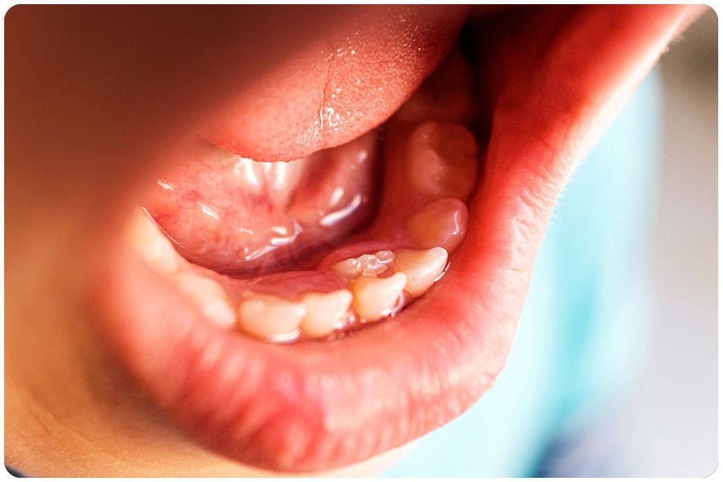 羊大师 | 孩子睡觉总磨牙,真的是因为缺钙吗?_影响_牙齿_解决方案