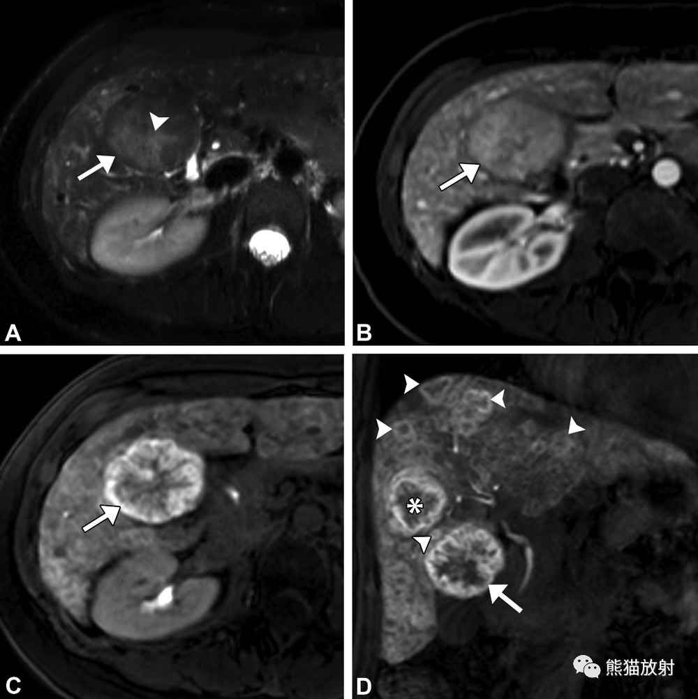 FNH及FNH样病变丨影像表现_信号_肝脏_中央