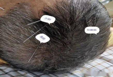 【临床医讯】龙砂开阖六气针法助力脑病康复_疾病_山东_系统