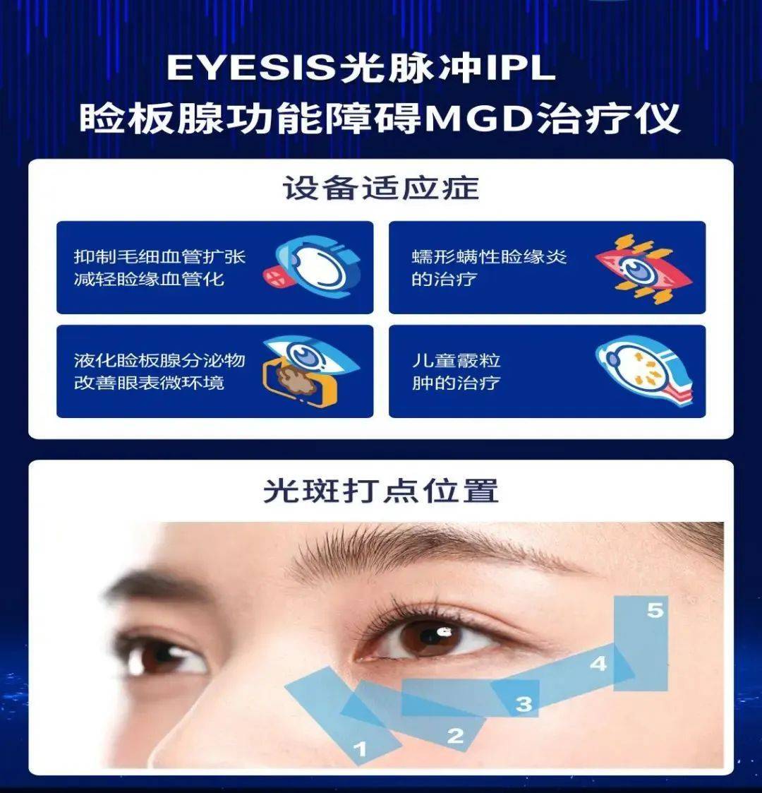 IPL强脉冲光的应用 | 干眼治疗 - 知乎