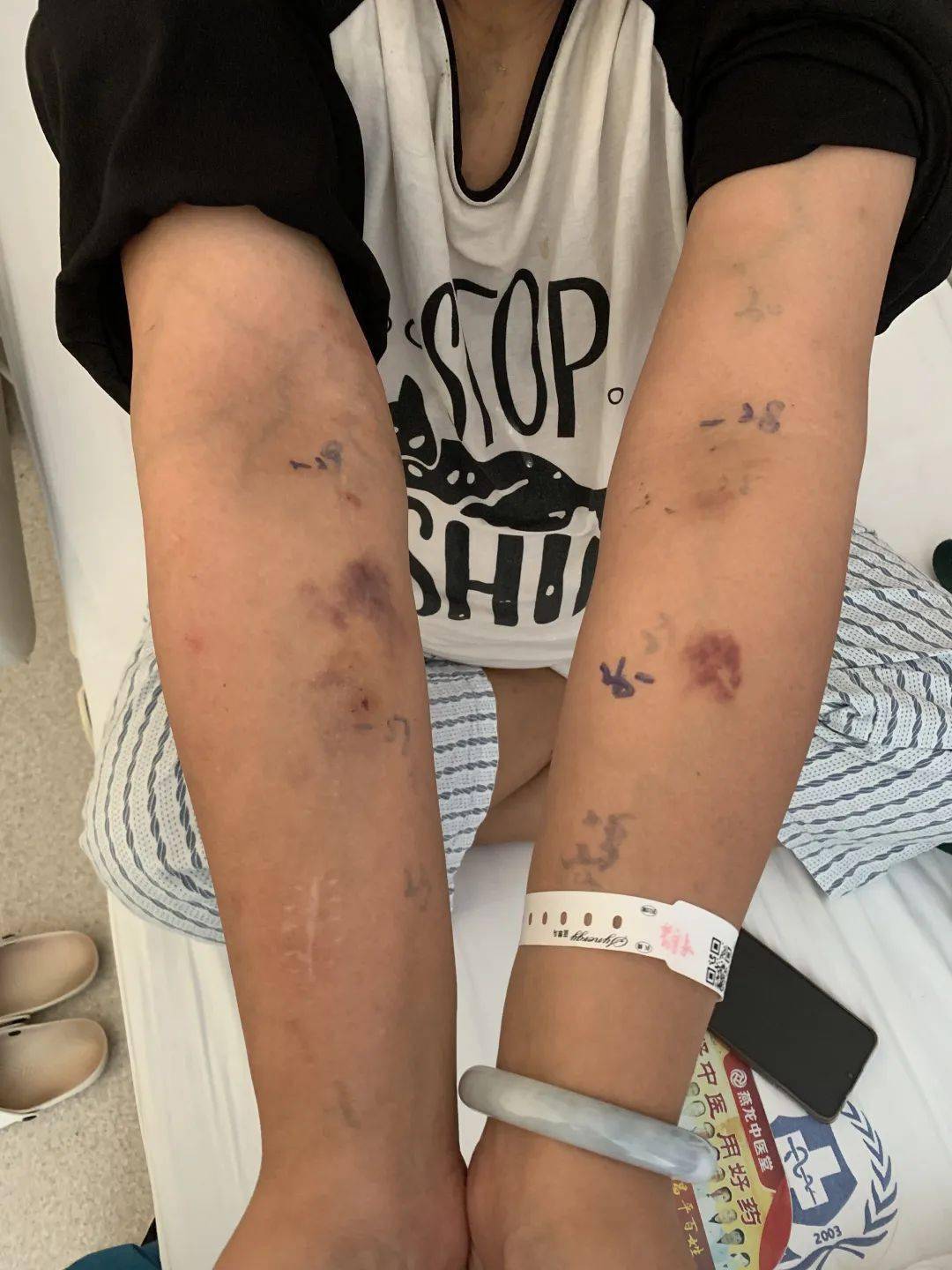 助推疑难血管精准穿刺我院透析中心帮扶南口医院扣眼穿刺经验分享