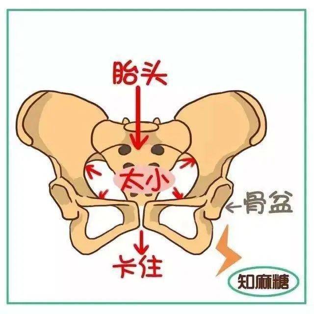 胎儿从阴道娩出的通道,就是医学上所说的产道,它包括骨通道和软产道