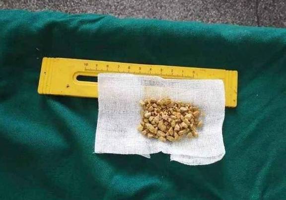 肾结石2厘米不手术可以吗?