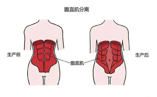 告别产后大肚，成为“小蛮腰精”