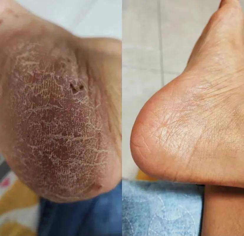 只用三天脚后跟干裂蜕皮就全消失了!_效果_时间_口子