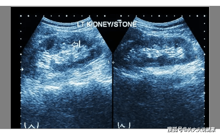 b超检查提示 右肾2枚结石