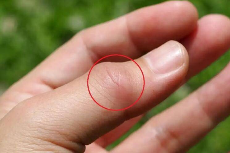 北京崇文门中医医院:手指经常莫名疼痛,或是这4个原因引起的,要及时