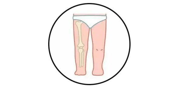 由于 o型腿行走姿势使膝盖外侧承重过大,使膝内侧骨骼生长较快