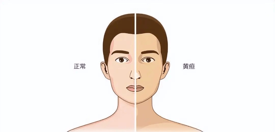 黄疸的典型表现为尿色加深,大便呈陶土白色,皮肤颜色发黄伴瘙痒.