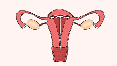 一般來說,宮內節育器應在年限到達時及時取出.
