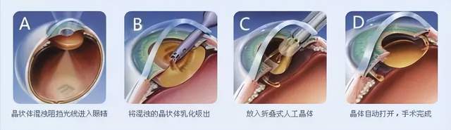 随着现代医学的进步和眼科手术设备及手术技术的发展,白内障手术已经