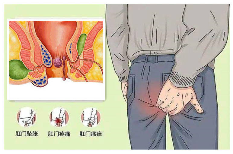 肛门周围水肿图片图片