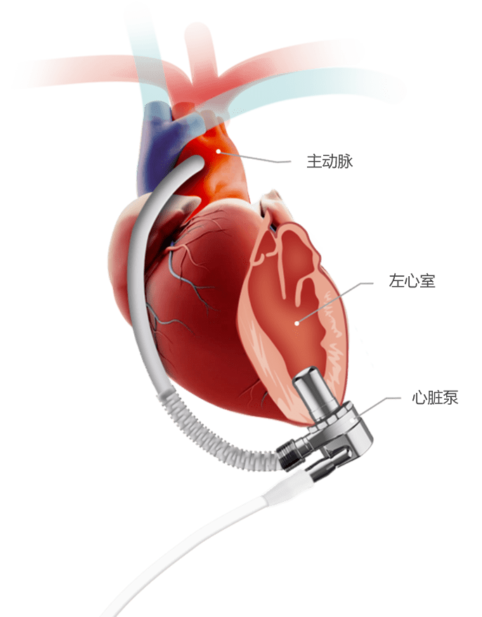 浙大儿院开始向社会招募受试者,可免费植入人工心脏_儿童_心力衰竭