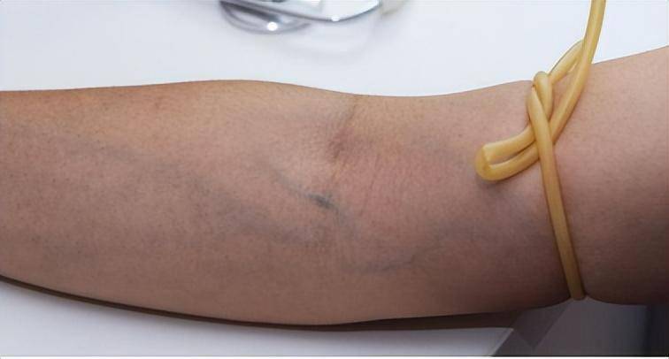 抽血时绑胳膊的橡皮管,是什么?