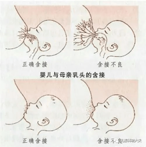 特殊的哺乳期乳房刺痛的元凶——乳头损伤_乳腺_济南市_治疗