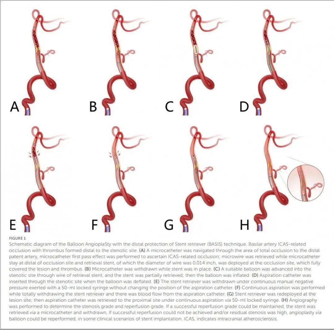 遠端取栓支架保護下的球囊血管成形術(basis技術)在顱內動脈粥樣硬化