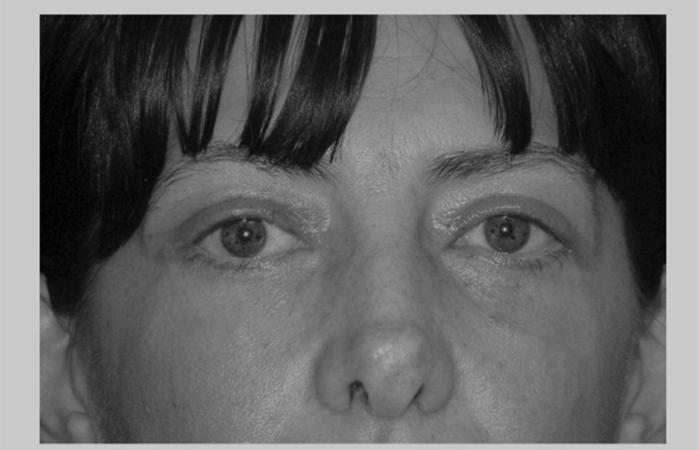 印第安纹剥离技术需要注意哪些问题?四个方面要警惕_化妆_情况_生水