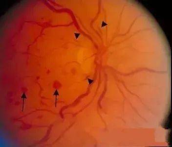 视网膜出血的10种类别,图文详解!_玻璃体_神经_外观