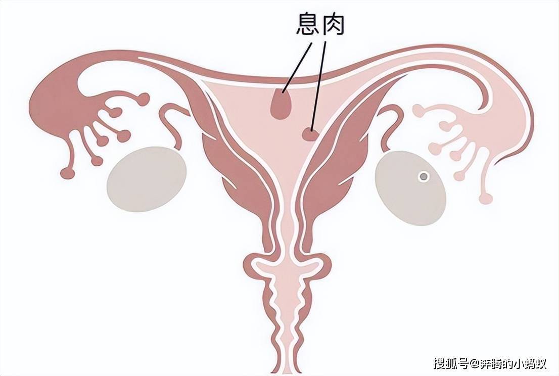 阻碍精液入宫:位于宫颈口的息肉会阻碍精子进入宫腔导致精子和卵子