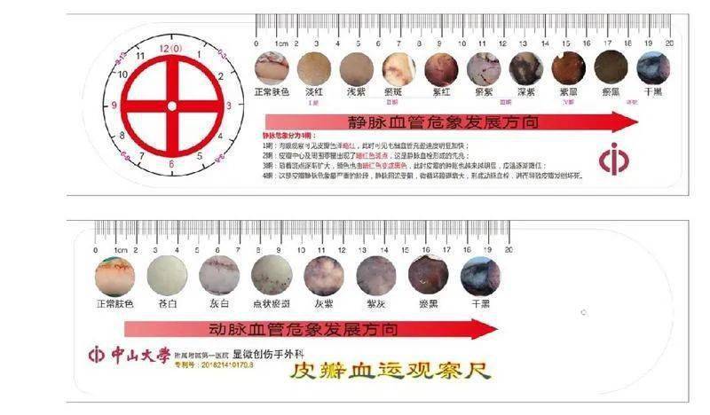 巧艳设计了一种皮瓣血运观察尺,在尺子的两面印有血管危象进展的图谱