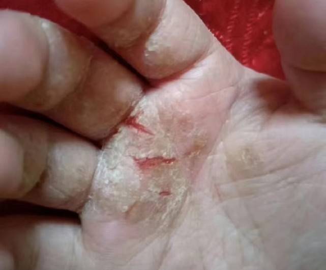 鱼鳞病皮服还有鸡皮肤(鱼鳞病为什么会伴发鸡皮肤)