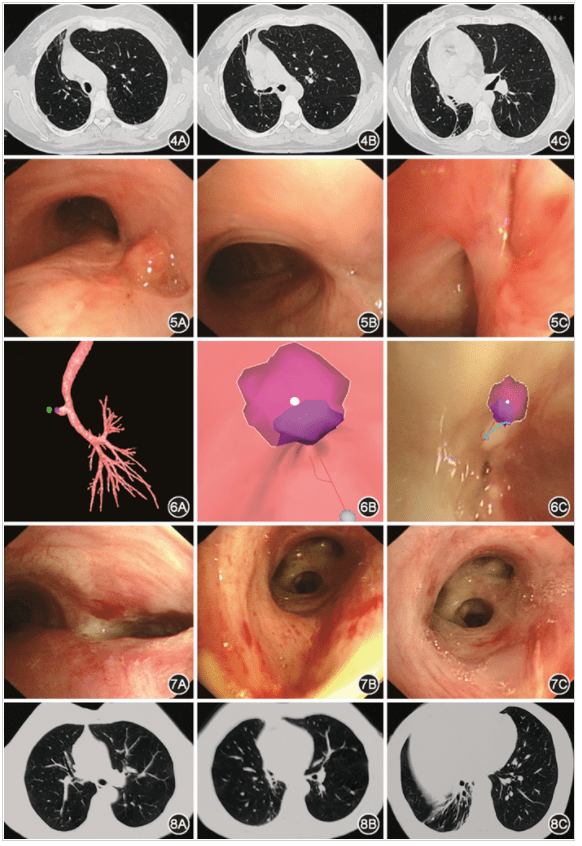 支气管镜纵隔造瘘复张右全肺及再通管腔闭塞型支气管结核1例_患者