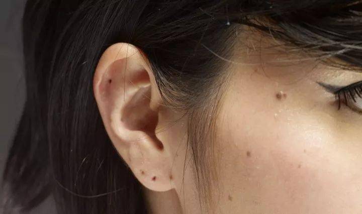 如果痣的存在影响到面部美观,想要去除一些良性的,小一点,色素比较浅