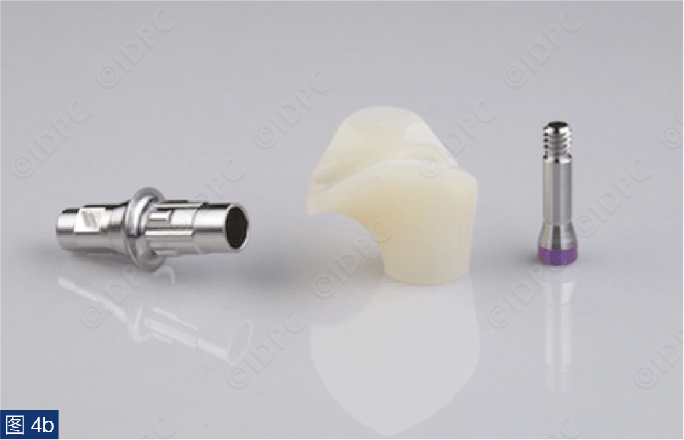 【精选案例】CAD/CAM愈合基台及美学区引导手术实现软组织轮廓保存：病例报告（美）_种植_牙龈