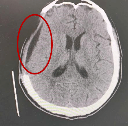 高压氧治疗硬膜下积液,效果杠杠!_患者_医学界_疾病