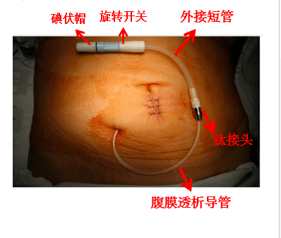 腹膜透析置管术图解图片