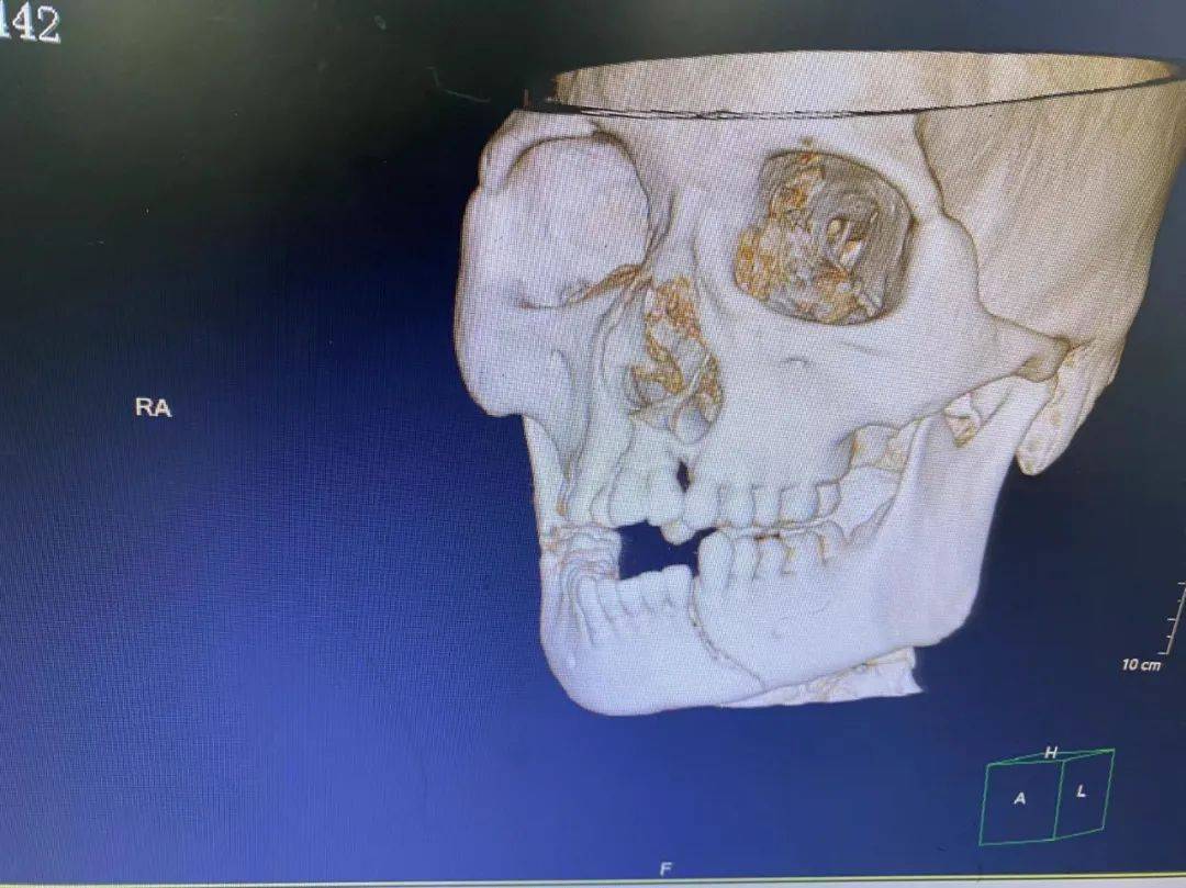 口腔科刘建伟医生进行深入病例讨论,考虑患者下颌骨骨折后张口受限