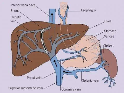 门静脉高压图解图片