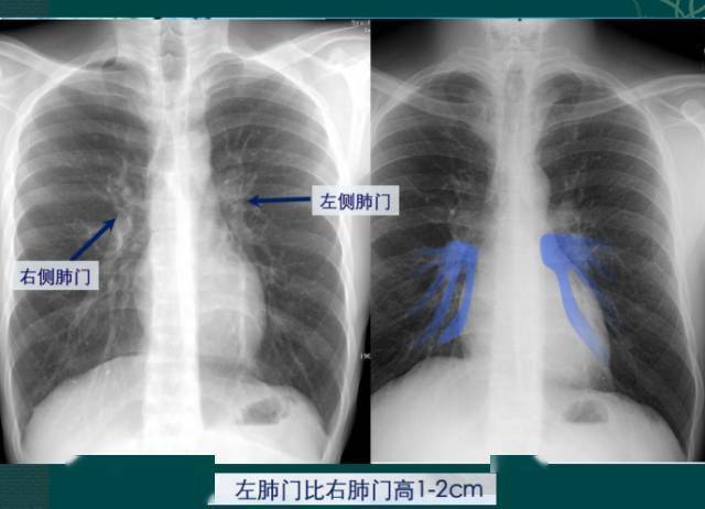 读完此文,终于学会看胸片了_纵隔_肺动脉_右肺