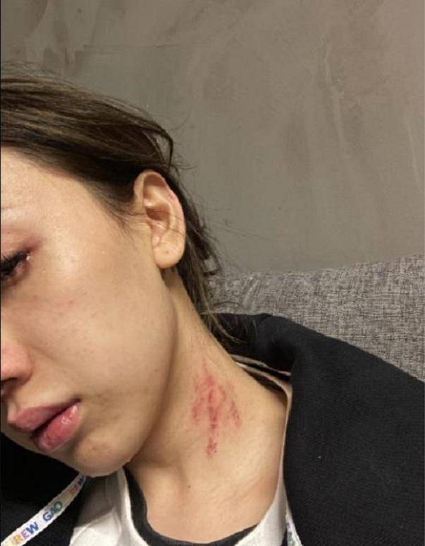 为了证明自己所说内容的真实性,女歌手特意发出她的脖子被抓伤的照片.