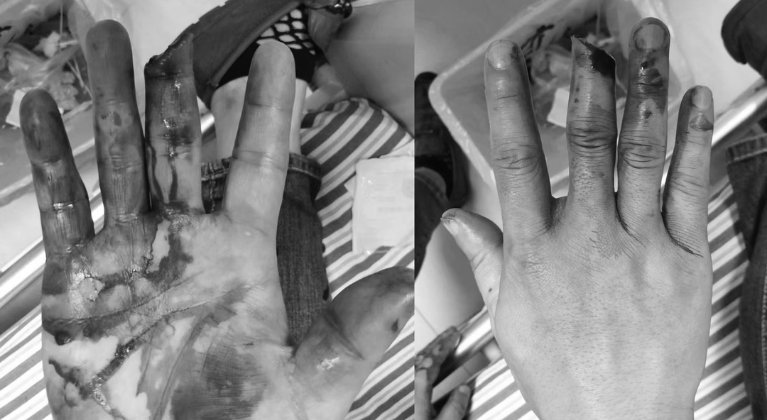 【厚德守责 精医为民】骨科医生妙手接断指,"截"后新生复如初