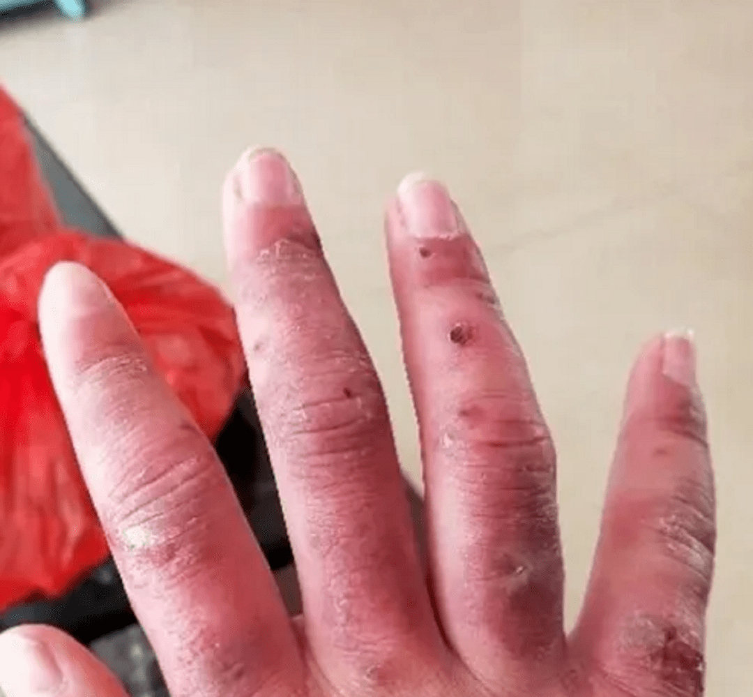 67冬天冻伤奇痒难忍!过来人教你一个小妙招,轻松消肿止痒不反复!