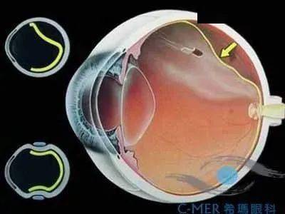 14岁男生近视1000度,就医时视网膜脱落已半年!