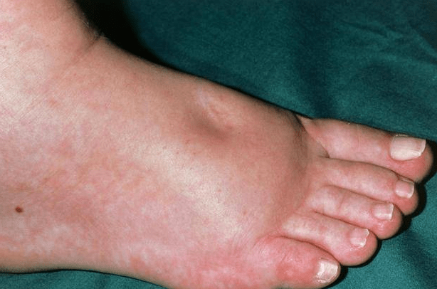 肝硬化下肢水肿怎么办?_症状_患者_蛋白