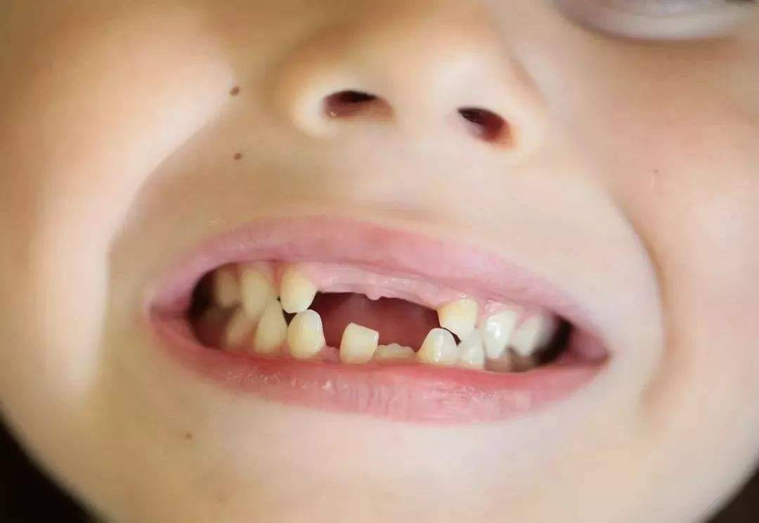 孩子的牙齿问题总出问题？可能是家长忽略了以下几个问题