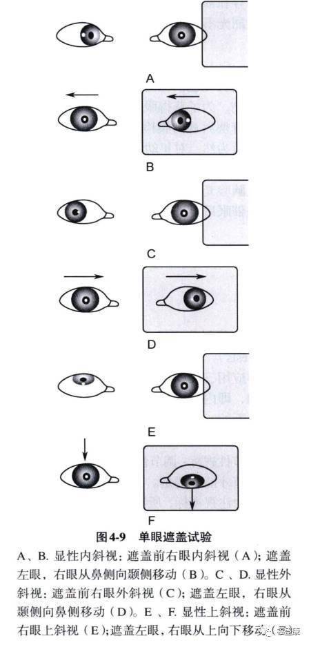 遮盖诫验“单眼遮盖试验”——《斜视弱视检查法》_手机搜狐网
