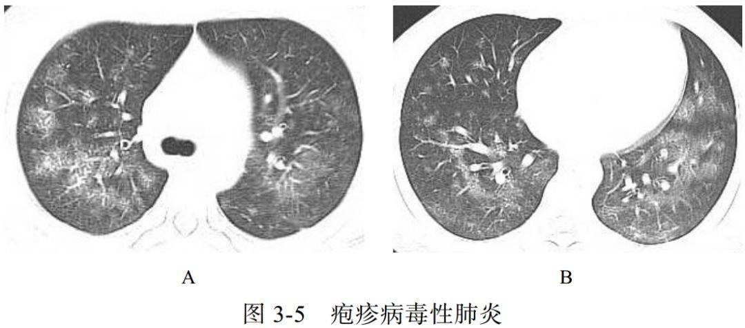 新冠肺炎ct早期征象与鉴别诊断_病灶_病理学_肺泡