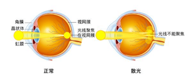 图1:正常眼睛和散光眼睛对比图散光是指平行光线经过眼球的屈光系统