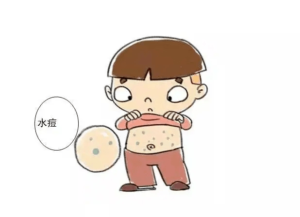 儿童感染水痘有哪些表现?